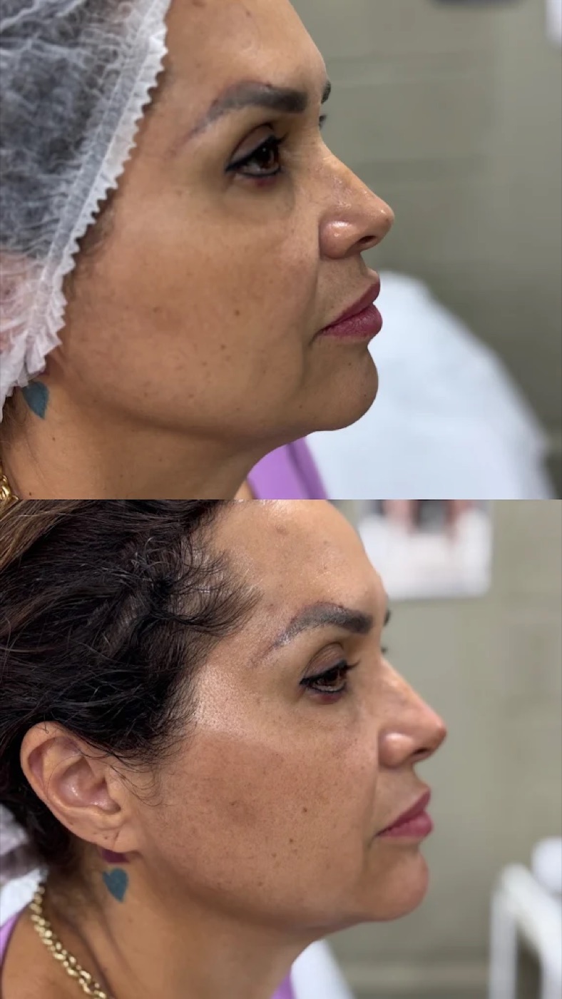 Resultado antes e depois no rosto