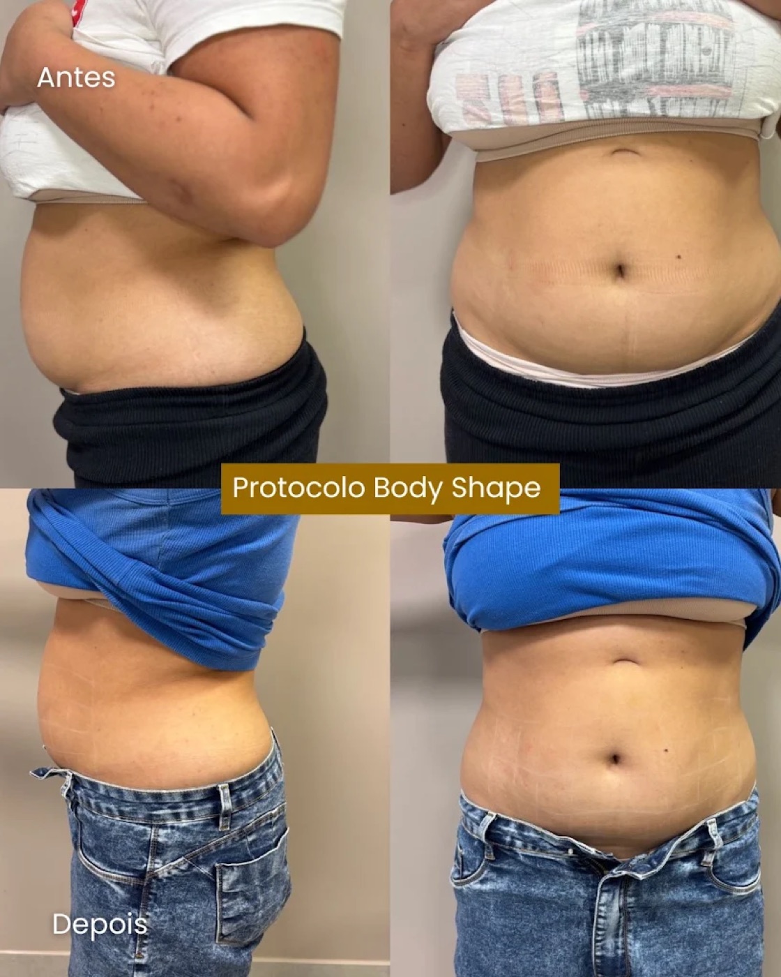 Resultado antes e depois de contorno corporal