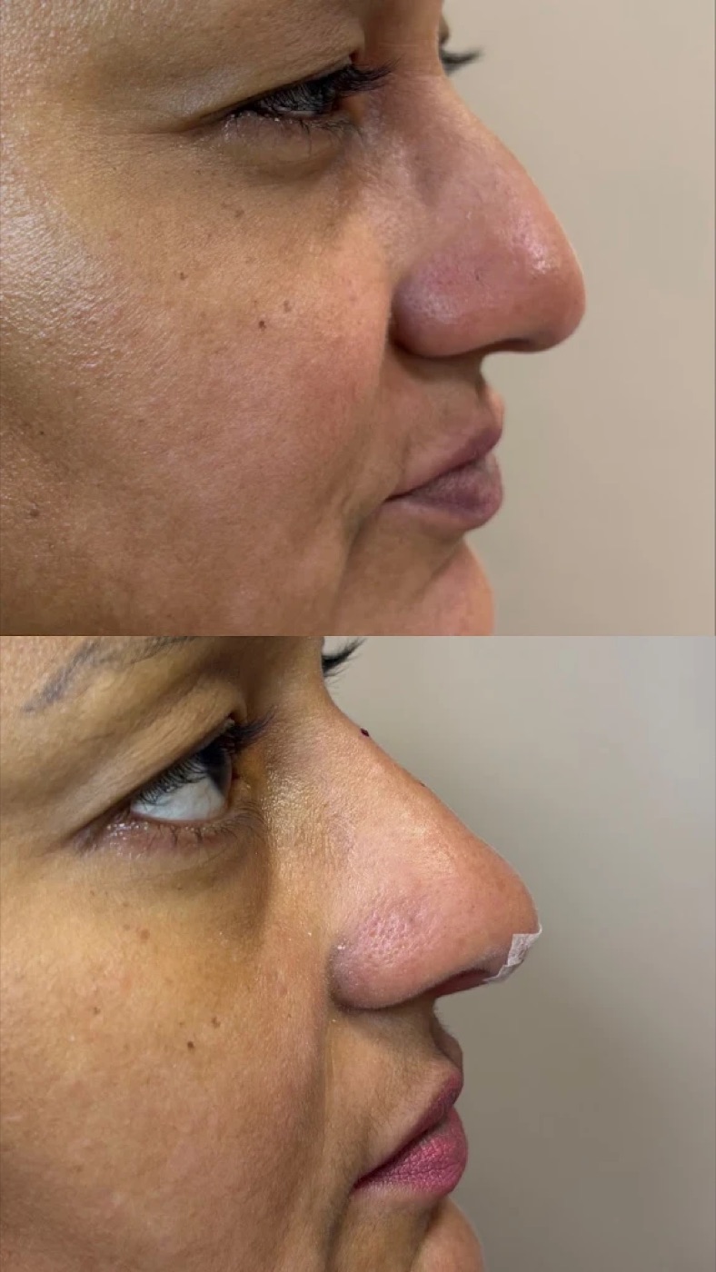 Resultado antes e depois no perfil do rosto