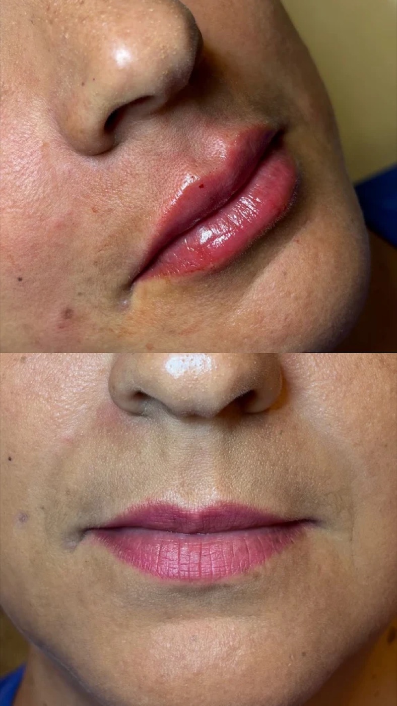 Resultado antes e depois de preenchimento labial