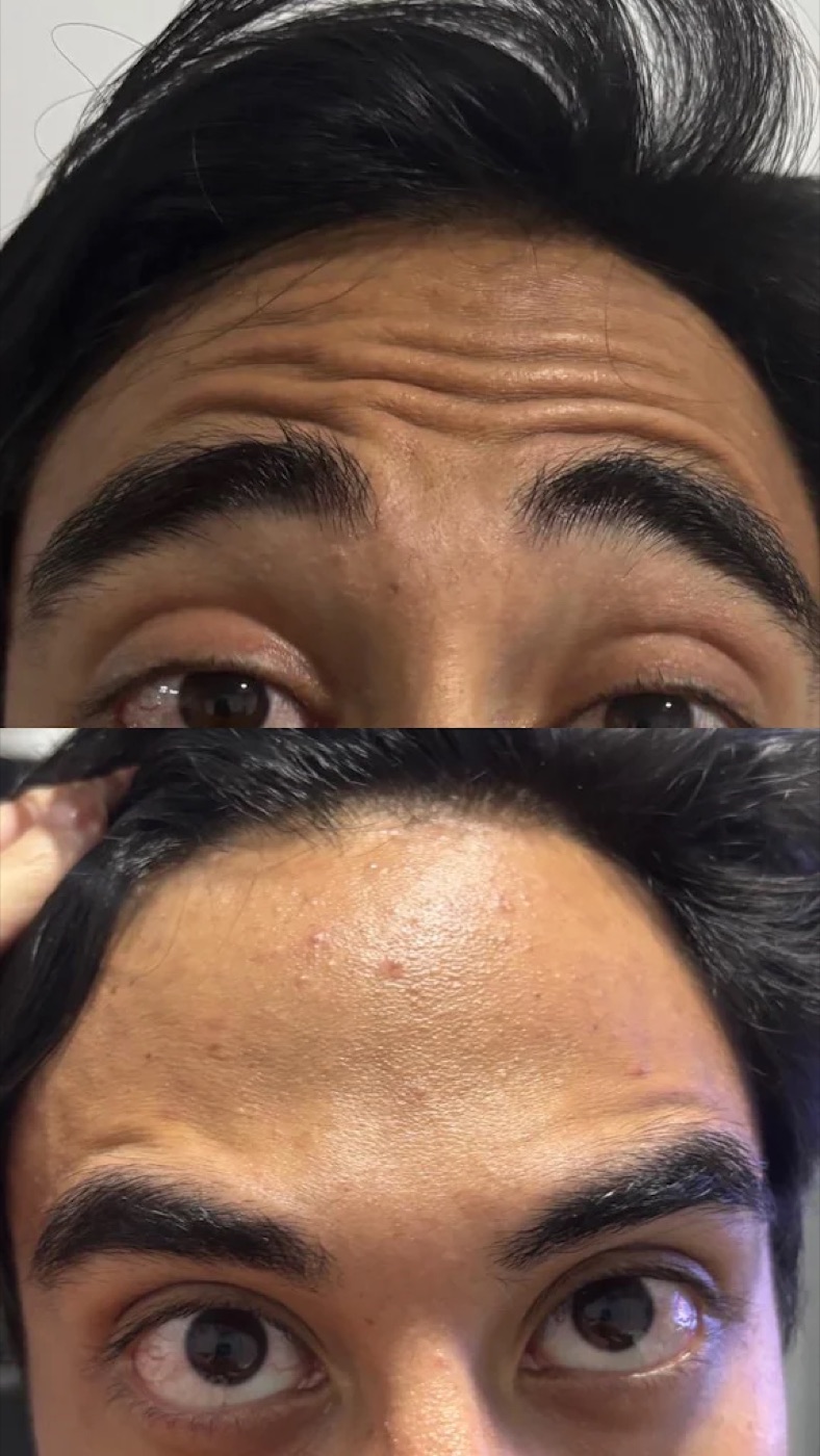 Resultado antes e depois de botox na testa