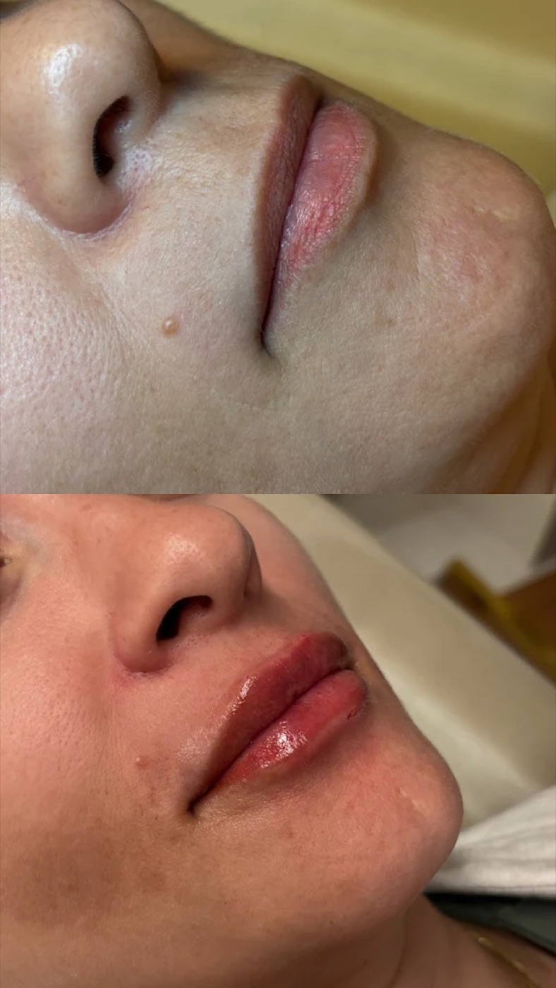 Resultado antes e depois de preenchimento labial