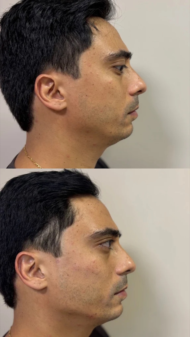 Resultado antes e depois no contorno do rosto