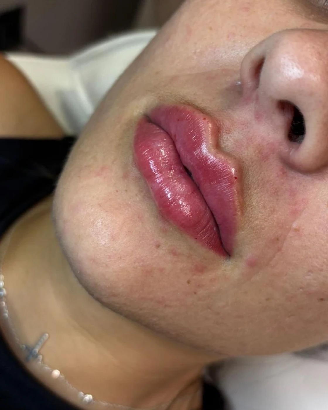 Resultado de preenchimento labial